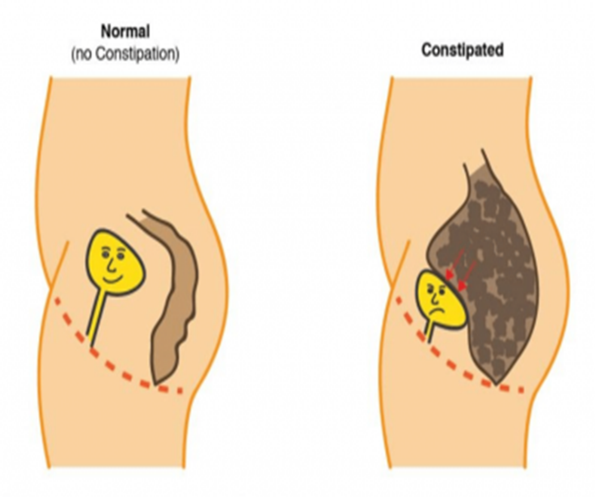 Why Can't I Poop? (Constipation) - Pelvic Health Physical Therapy