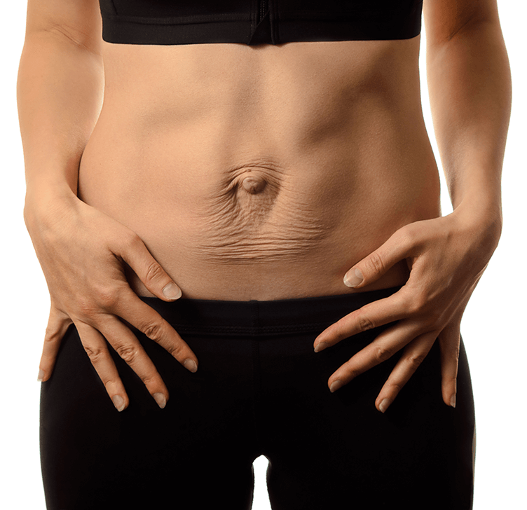 Diastasis Recti